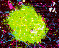 Beta-Amyloid Plaque Surrounded by Tangles